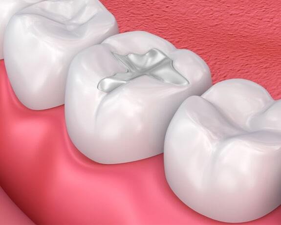 Dental filling illustration showing tooth restoration with gray composite material on molars against pink gum background.