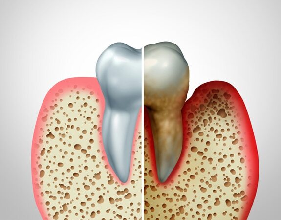 Healthy tooth and diseased tooth cross-section showing bone loss from periodontal disease.