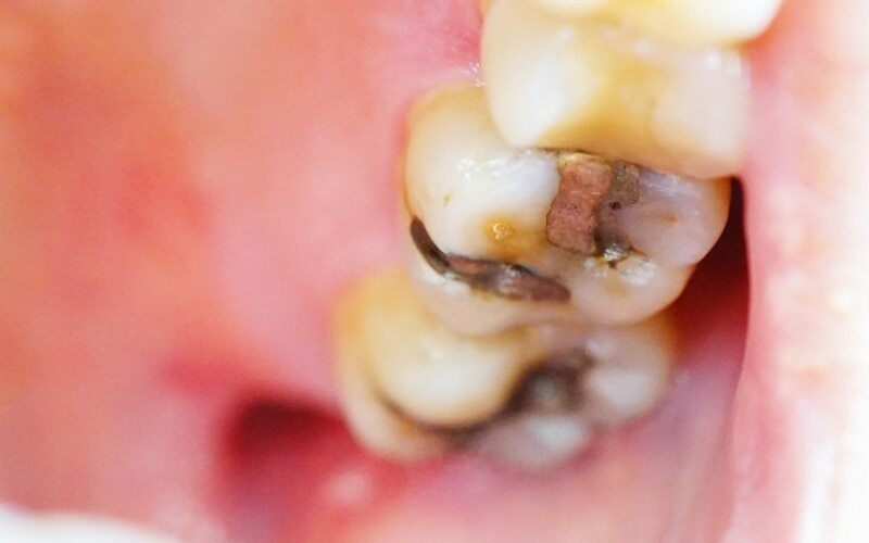 Close-up of tooth with dark cavity and filling material showing decay before treatment.