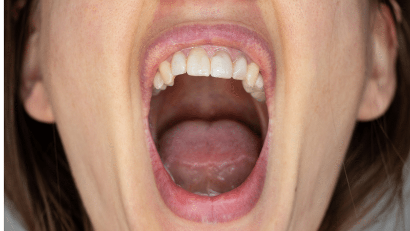 Close-up of open mouth showing healthy white teeth and tongue related to roof of mouth conditions.