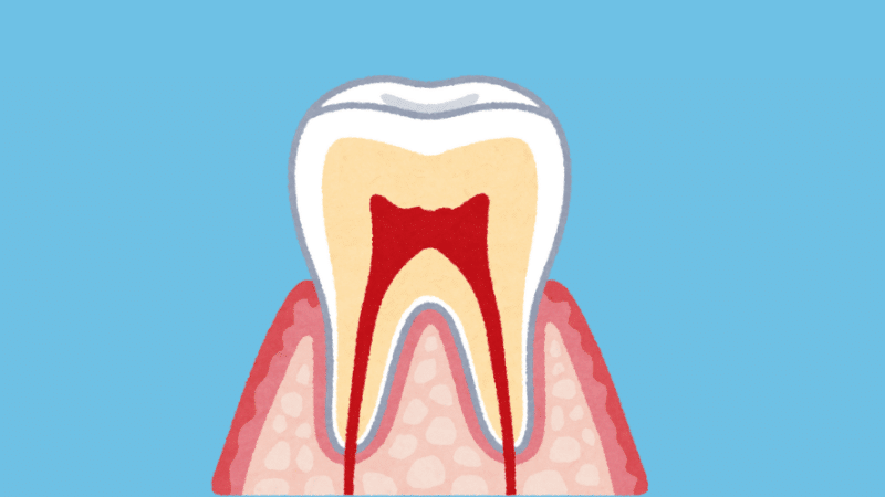 Anatomical diagram showing tooth pulp inflammation requiring endodontic treatment.
