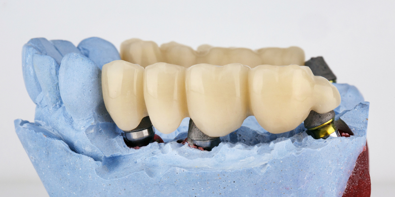 Dental bridge restoration model showing ceramic tooth crowns on blue dental model base.