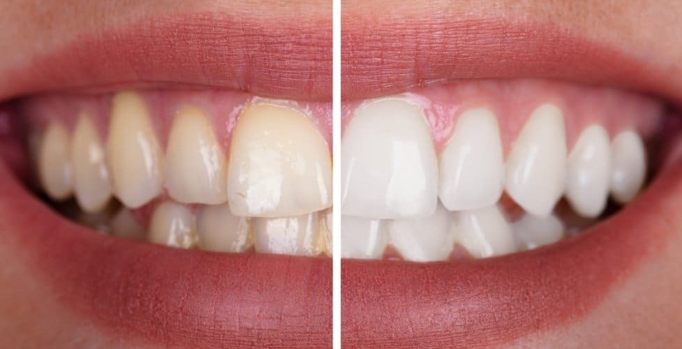 Before and after teeth whitening comparison showing natural tooth shade improvement.
