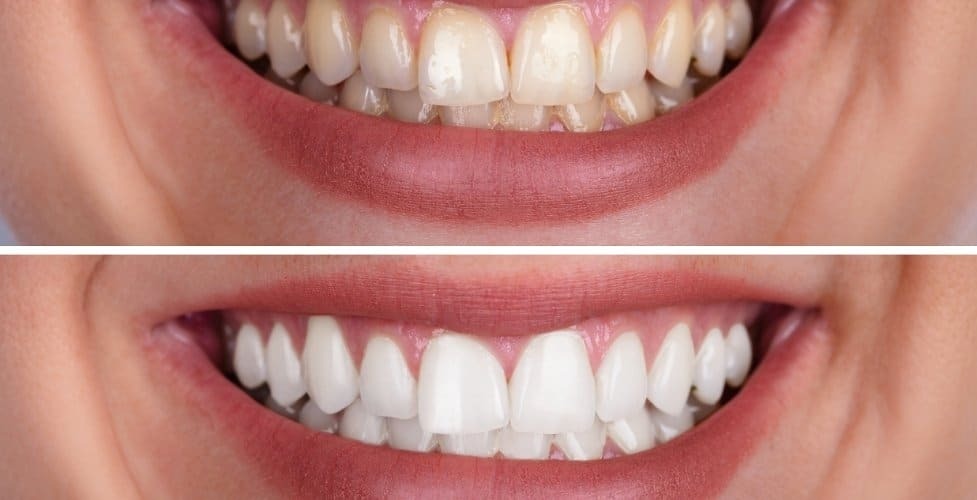 Before and after teeth whitening results showing natural smile transformation.