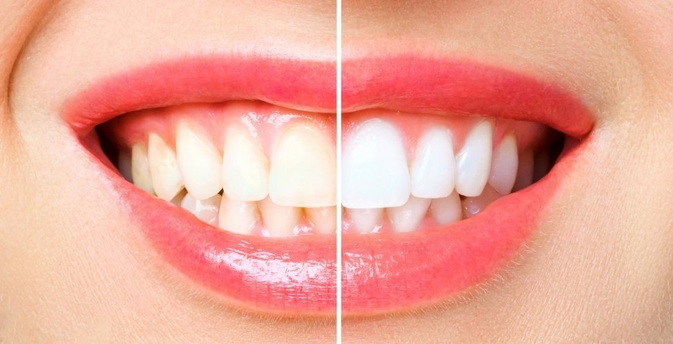 Before and after teeth whitening comparison showing whiter, brighter teeth on the right side.