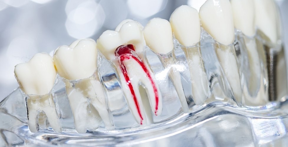 additional treatment following a root canal procedure