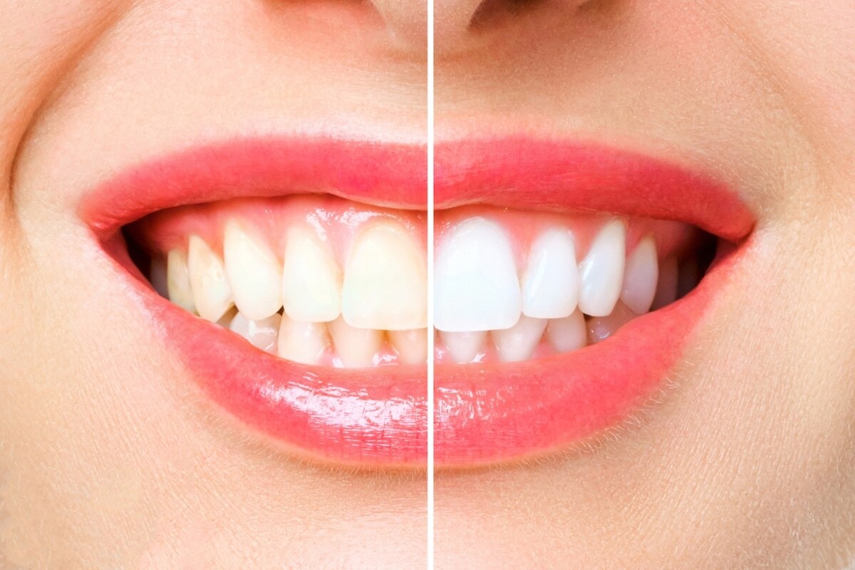 Before and after teeth whitening results showing improved brightness and shine.