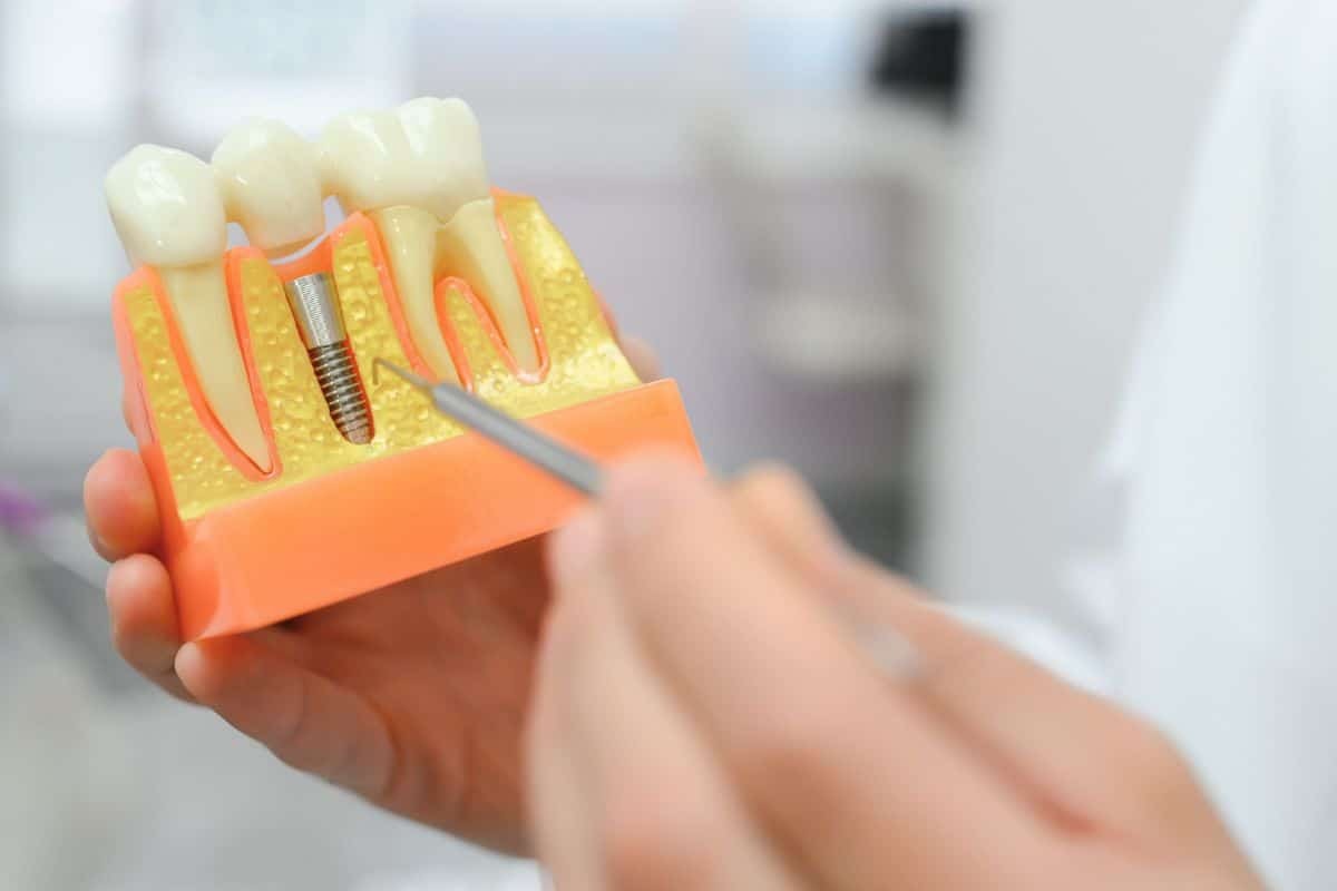 Dental implant model showing titanium screw placement in jawbone for long-term tooth replacement.