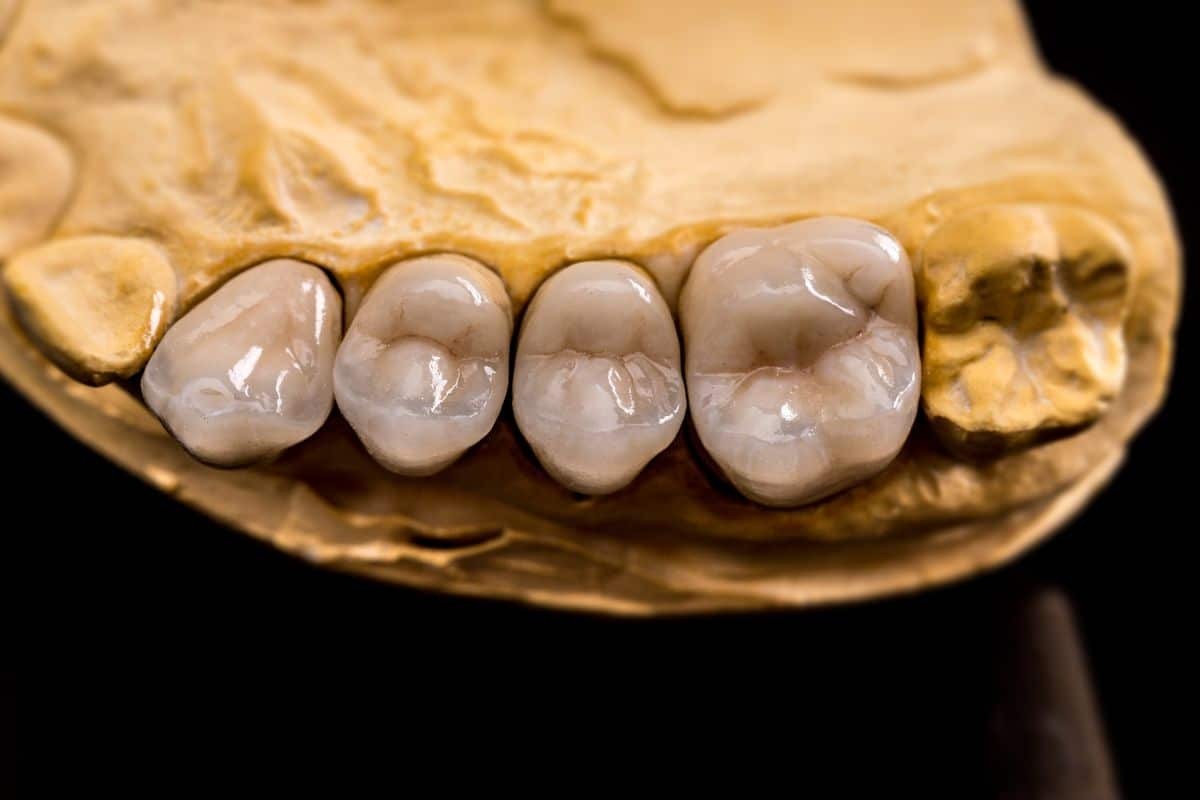 Four tooth-colored dental crowns displayed on a gold model showing smile aesthetic improvement.