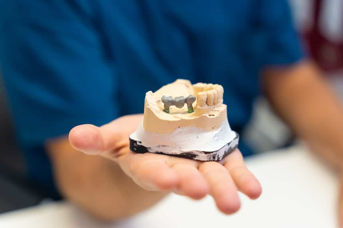 Dentist holding dental crown model with implant posts and gum tissue base.