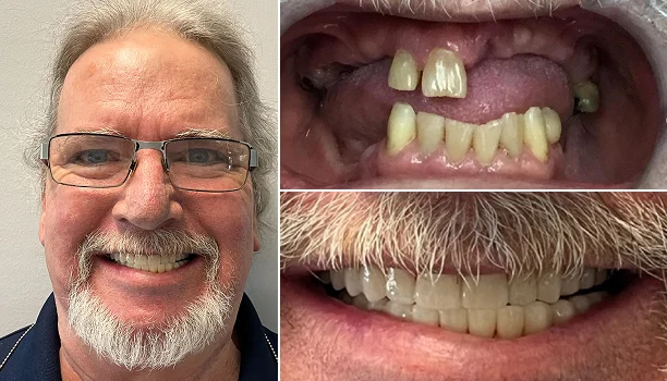 Before and after dental implants: an older man’s gapped, missing teeth replaced with a full smile