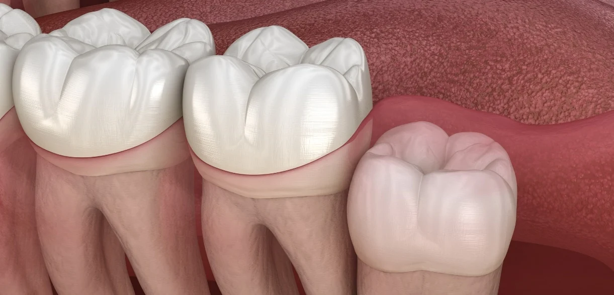 Home Remedies For Soothing Wisdom Teeth Discomfort
