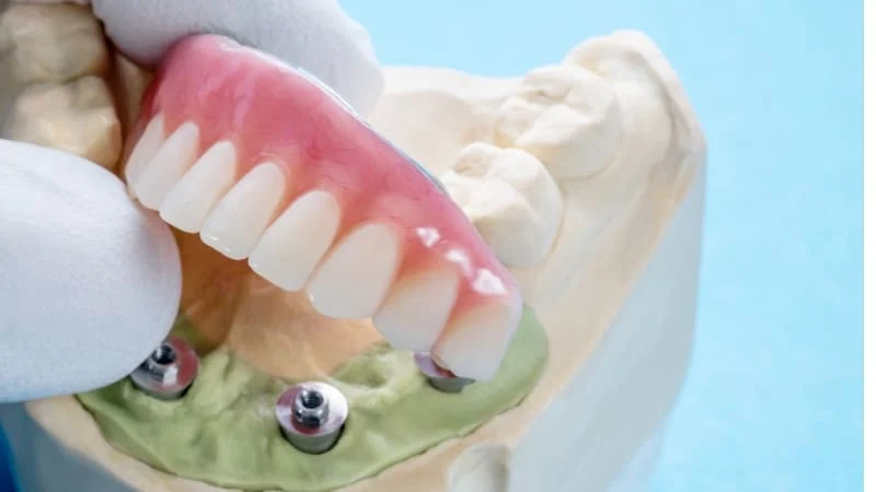 Implant-supported full arch denture on a dental model