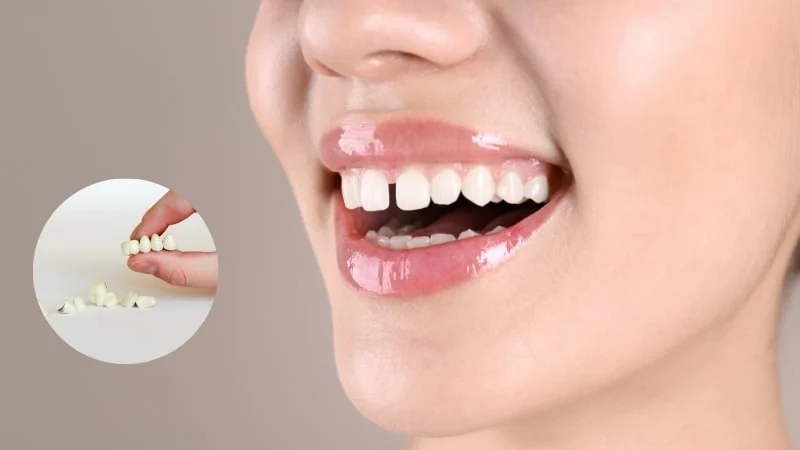 Can Dental Crowns Fix Gaps Between Teeth?