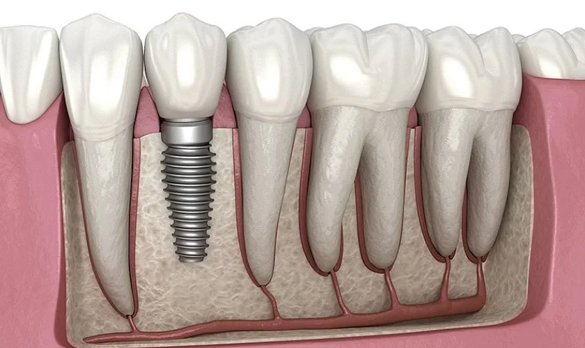 Illustration of a dental implant between natural teeth