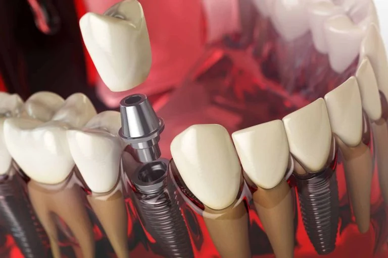 Model of a dental implant replacing a missing tooth between natural teeth