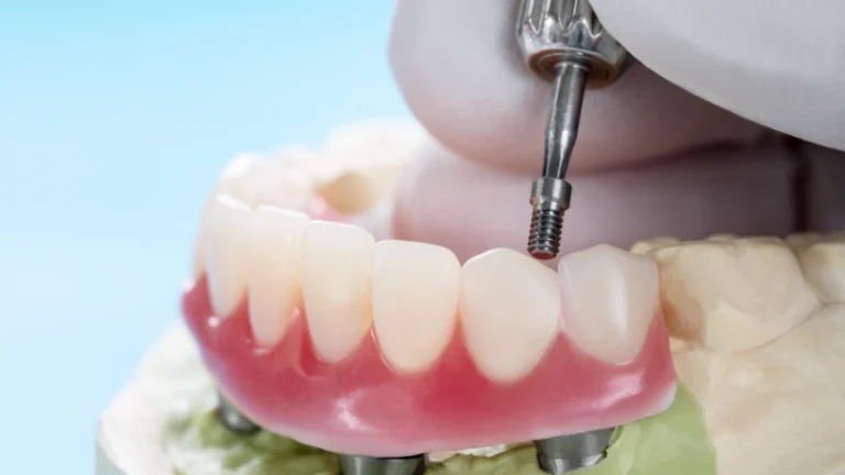 Full arch denture being fitted onto dental implants on a model