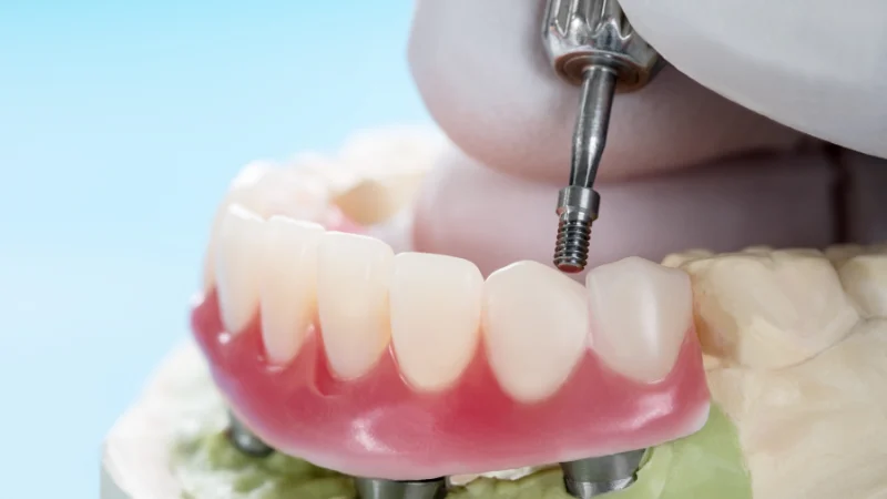Full arch denture being fitted onto dental implants on a model