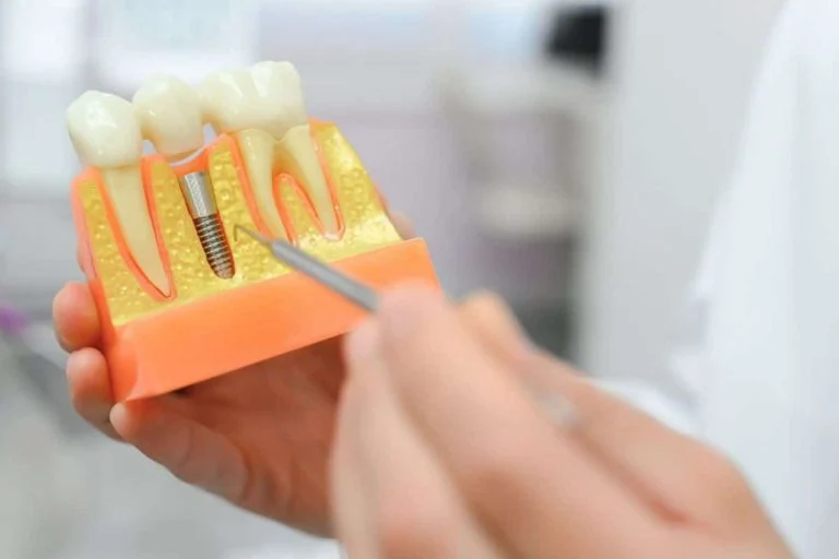 Hand holding a dental implant model