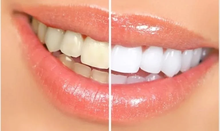 Smile showing stained teeth on one side and whitened teeth on the other