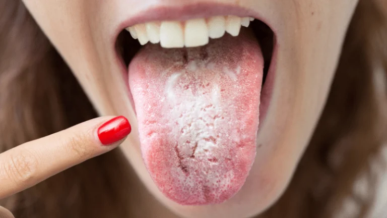 Tongue with a white coating